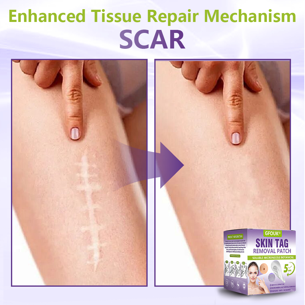 GFOUK® Soluble Microneedle Botanical Skin Tag Removal Patch 🔥
