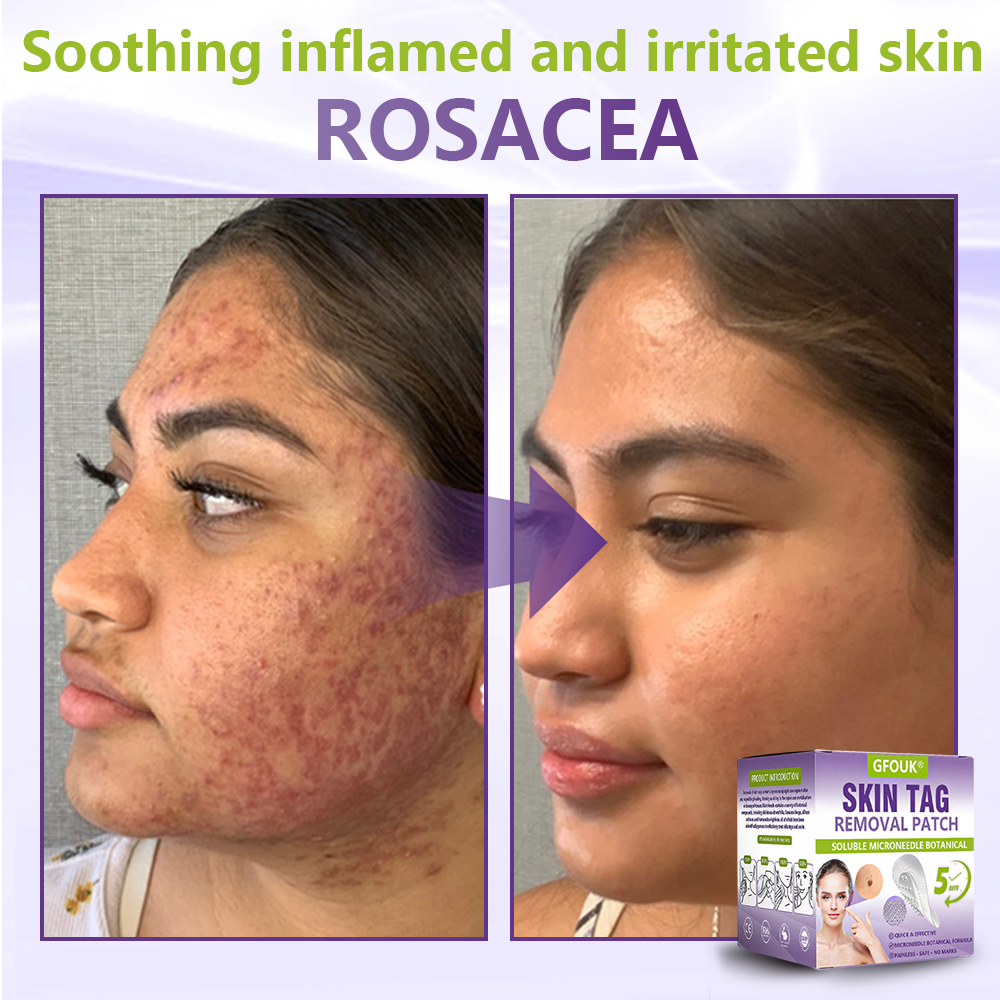 GFOUK® Soluble Microneedle Botanical Skin Tag Removal Patch  🔥