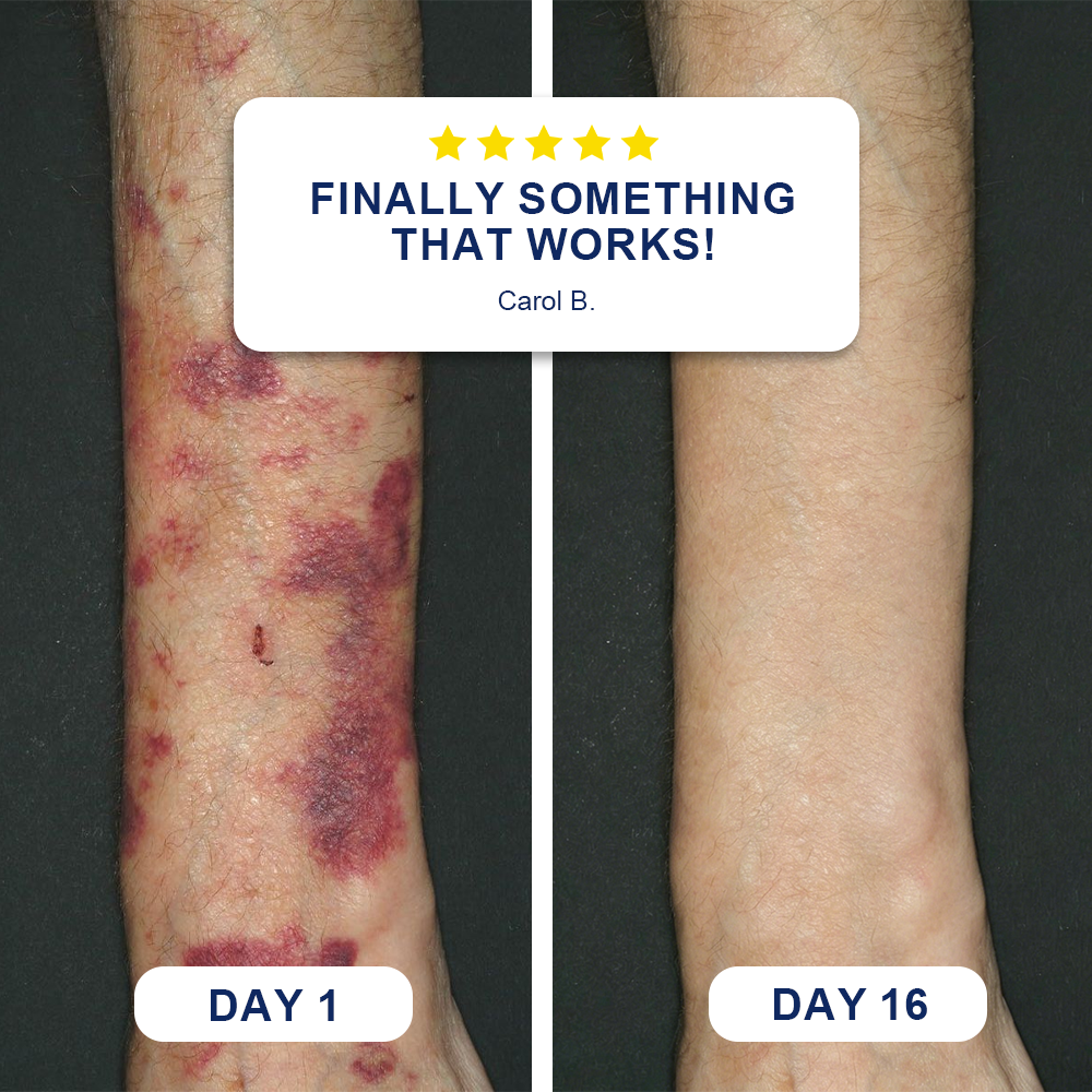 ✨Evolvion® Bruise Repair & Skin-Strengthening Cream (up)