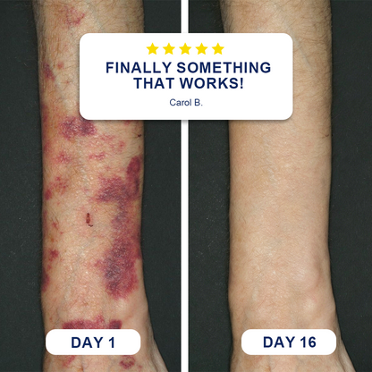 ✨Evolvion® Bruise Repair & Skin-Strengthening Cream (up)