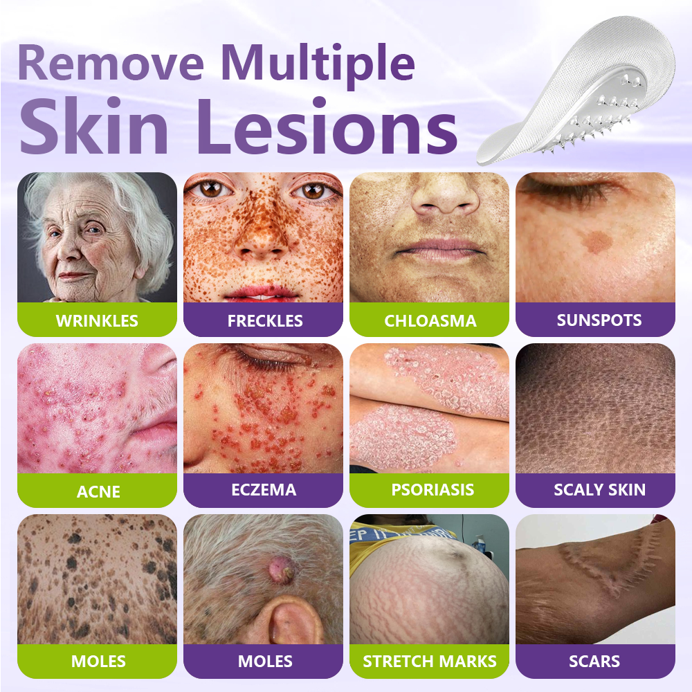 GFOUK® Soluble Microneedle Botanical Skin Tag Removal Patch  🔥