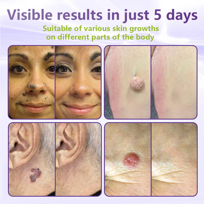 GFOUK® Soluble Microneedle Botanical Skin Tag Removal Patch  🔥