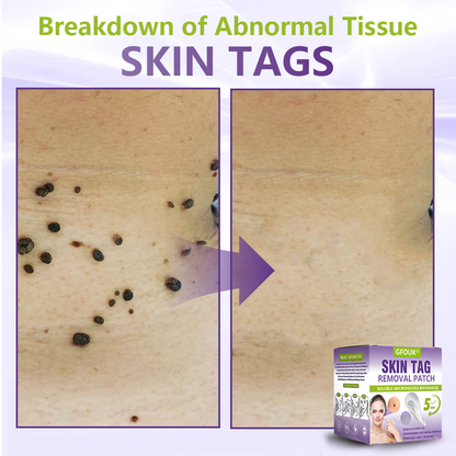 GFOUK® Soluble Microneedle Botanical Skin Tag Removal Patch  🔥