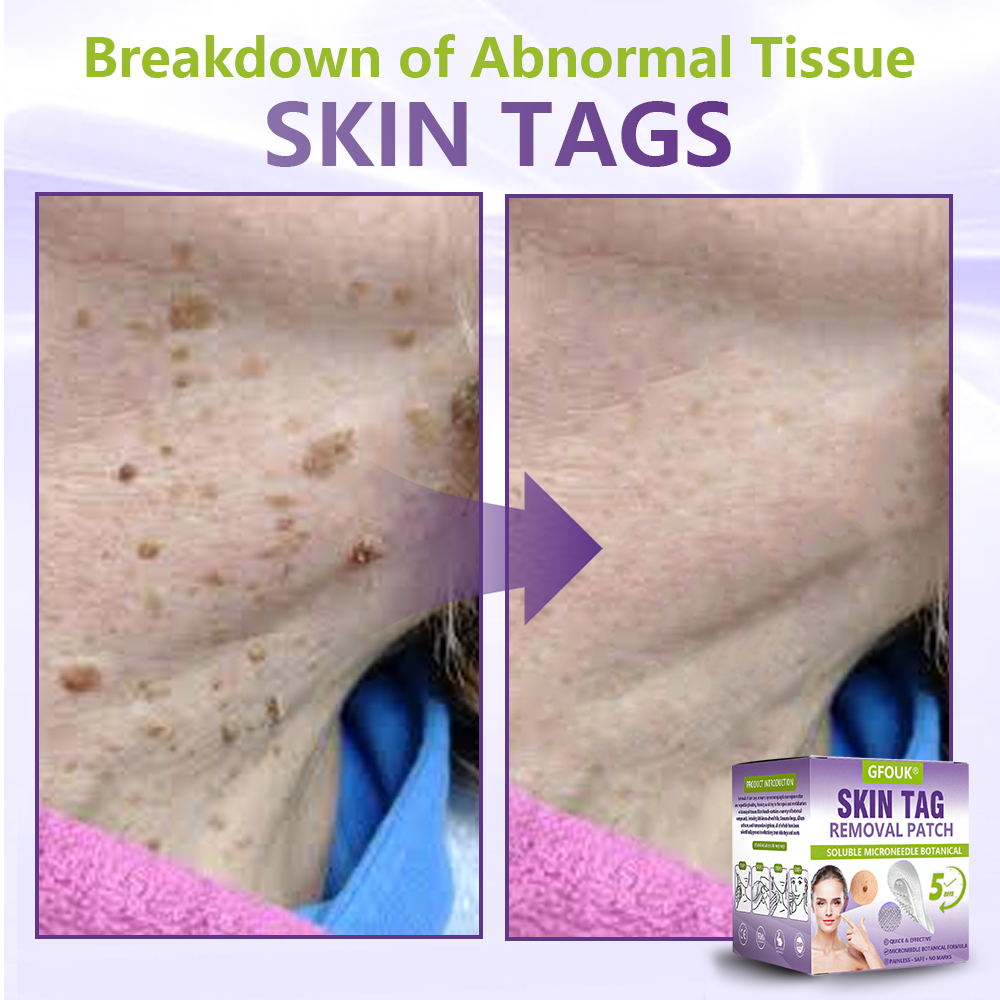 GFOUK® Soluble Microneedle Botanical Skin Tag Removal Patch  🔥