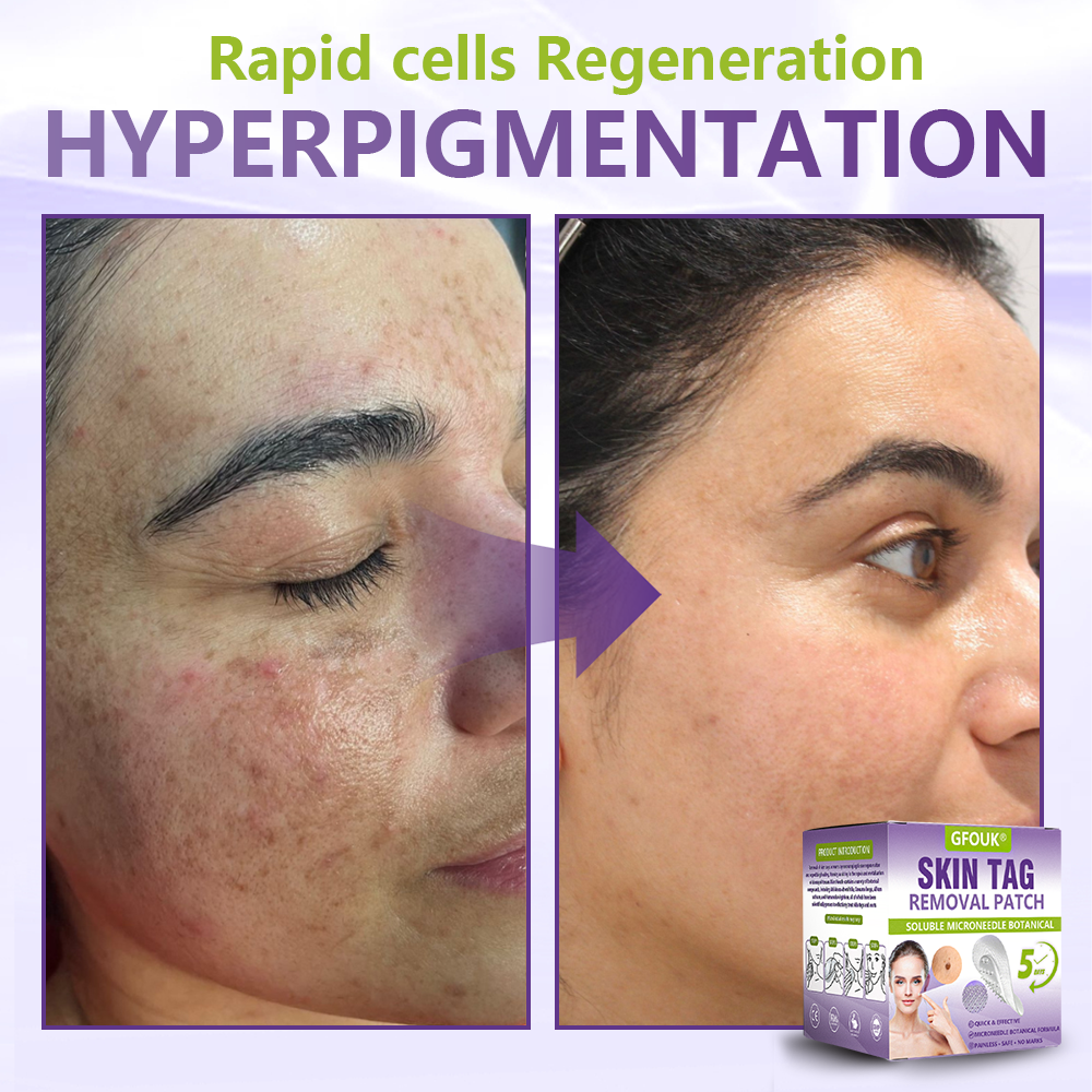 GFOUK® Soluble Microneedle Botanical Skin Tag Removal Patch  🔥