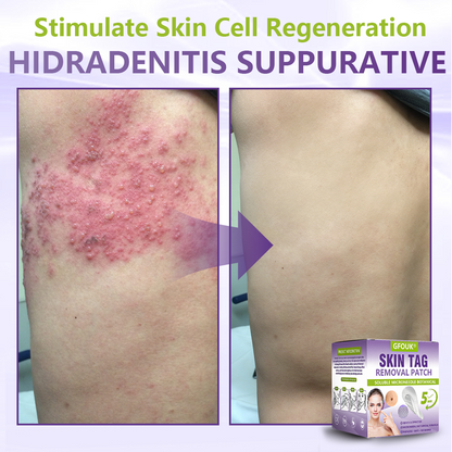 GFOUK® Soluble Microneedle Botanical Skin Tag Removal Patch  🔥