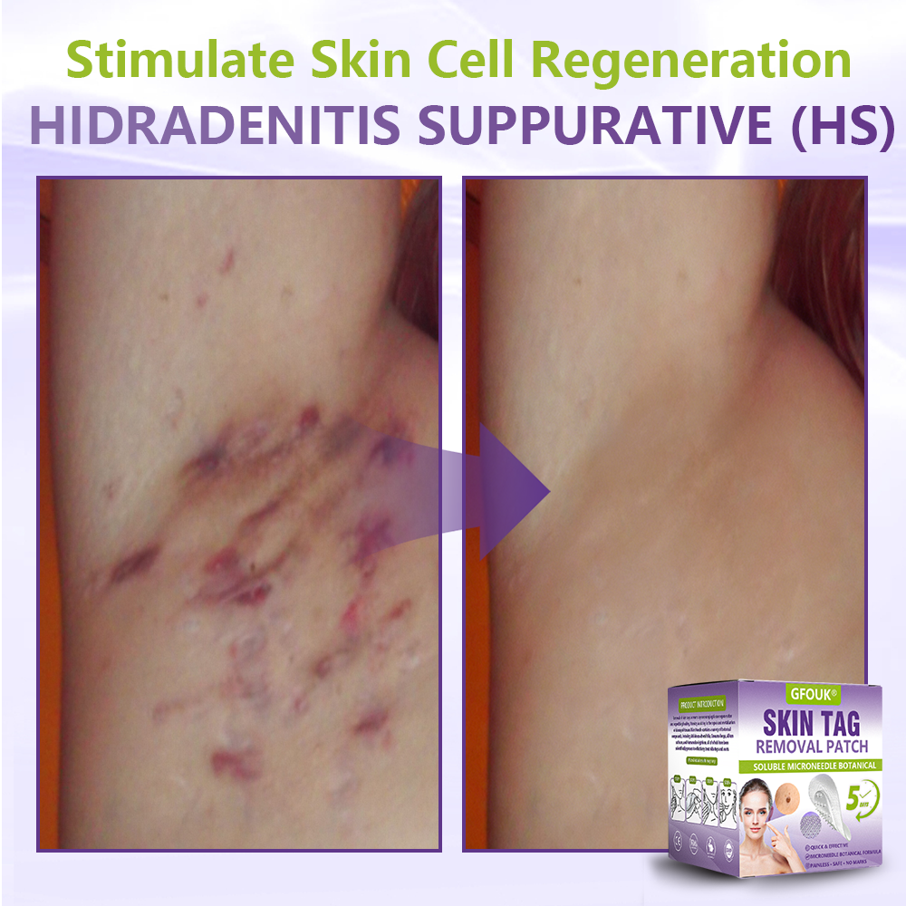GFOUK® Soluble Microneedle Botanical Skin Tag Removal Patch  🔥